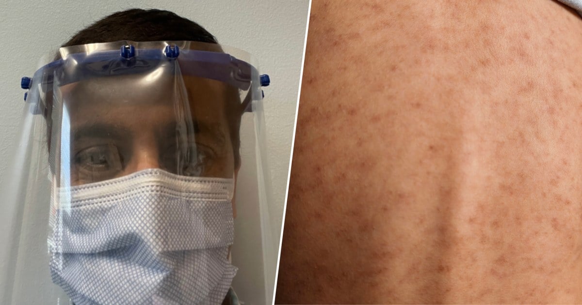 I’m a Doctor Who Treated Measles in the 2015 Outbreak. 7 Things People Keep Getting Wrong