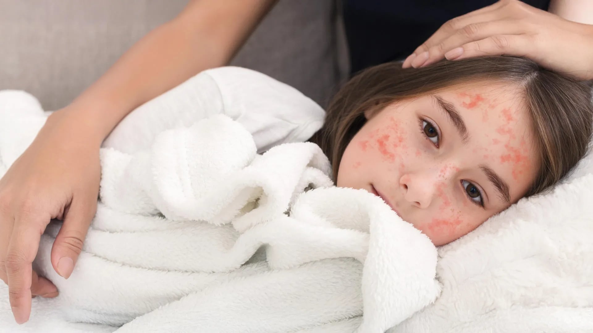 Un nuovo antivirale potrebbe fermare il morbillo prima che scoppi un'epidemia