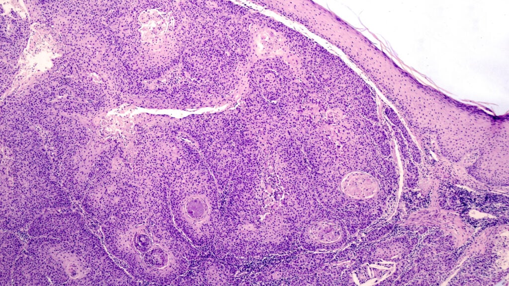 FDA panel endorses Replimune's previously rejected melanoma drug